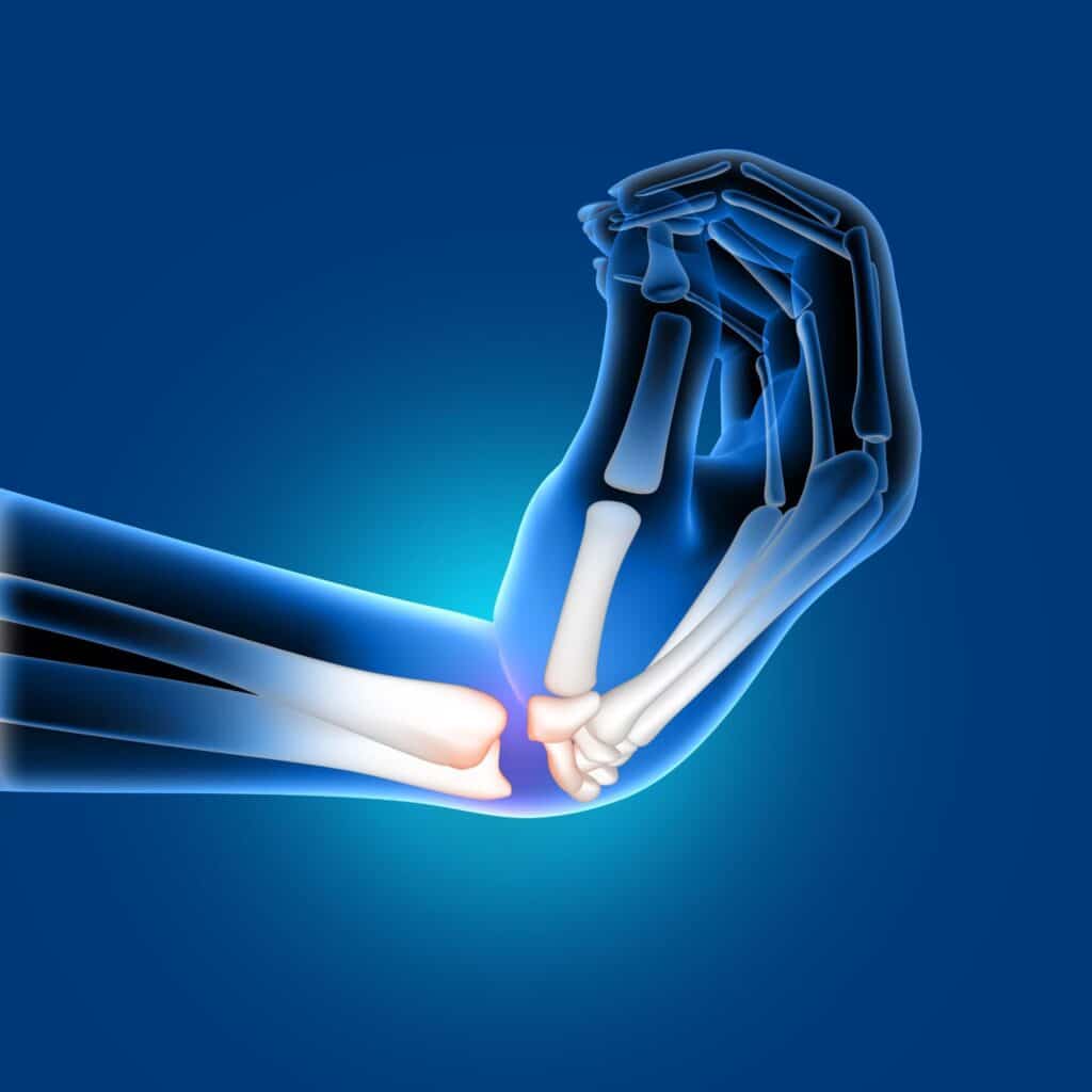 carpal tunnel syndrome