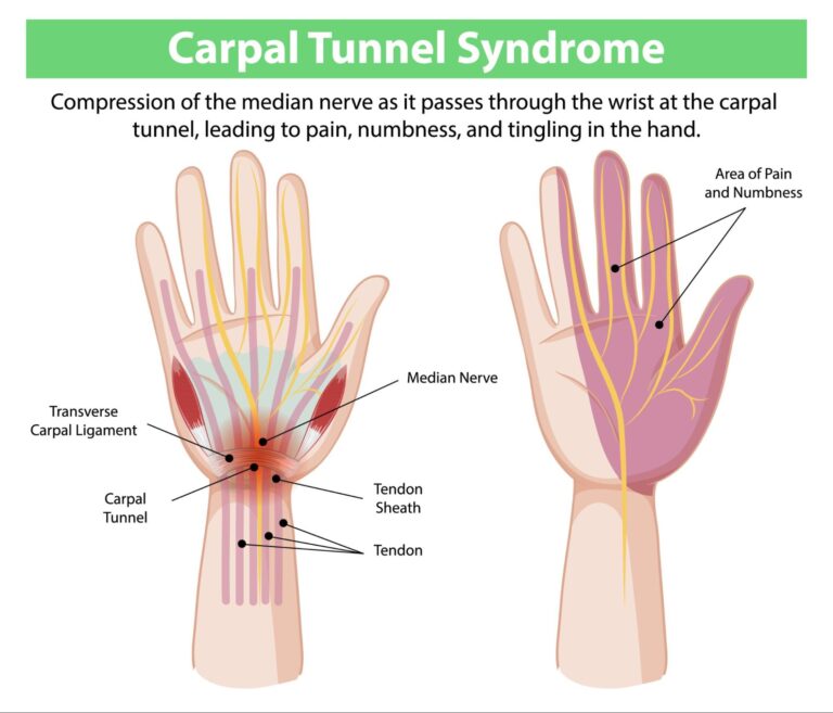 carpal tunnel syndrome symptoms