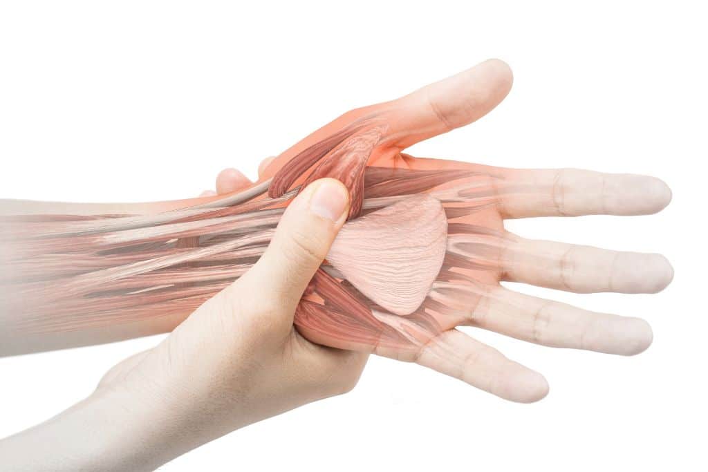 Illustration of a painful hand with nerves and muscles highlighted to explain radiculopathy vs neuropathy